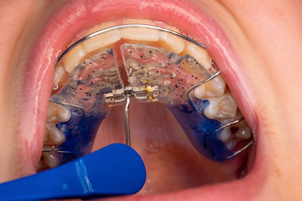How A Palatal Expander Works