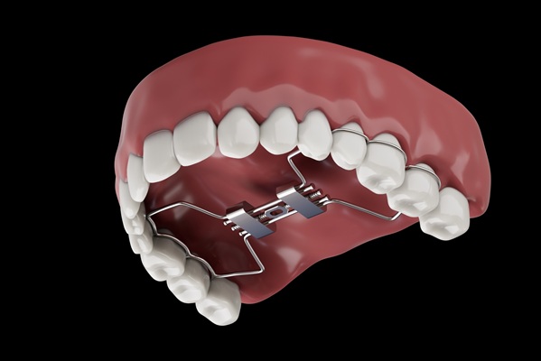How Palate Expanders Work